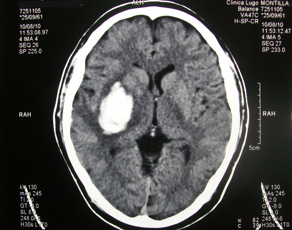 Tac_Craneo_Hematoma_Parietal